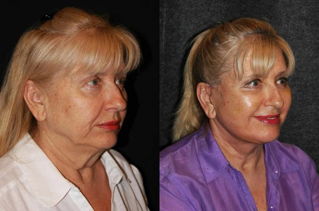Как выглядит женщина в 70 лет без пластики фото